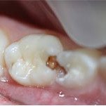 Пораженные кариесом молочные зубы