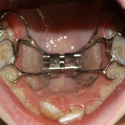 Несъемный ортодонтический аппарат