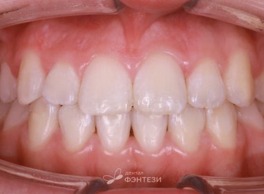 Идеально ровные зубы после лечения на брекетах!