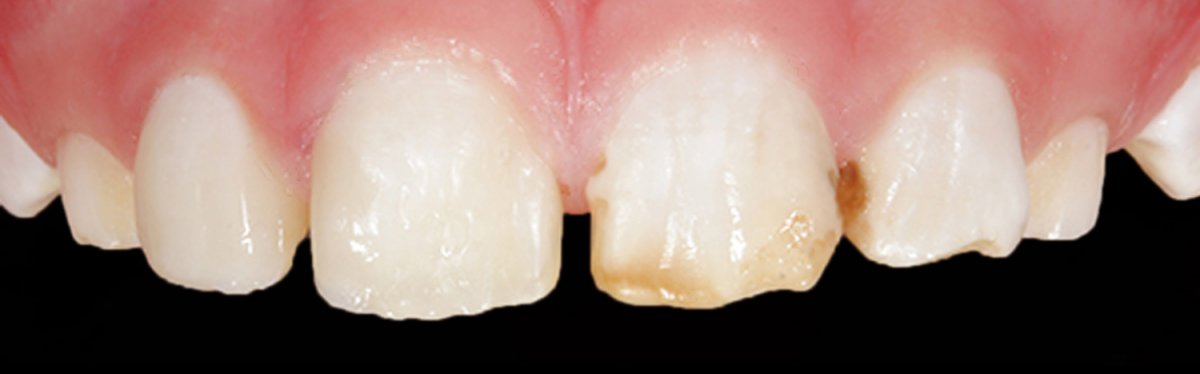 Лечение флюороза у детей