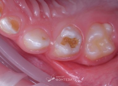 Пролечили 13 зубов малышу в наркозе