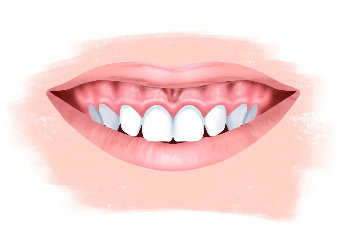 Десневая улыбка у ребенка – стоит ли беспокоиться