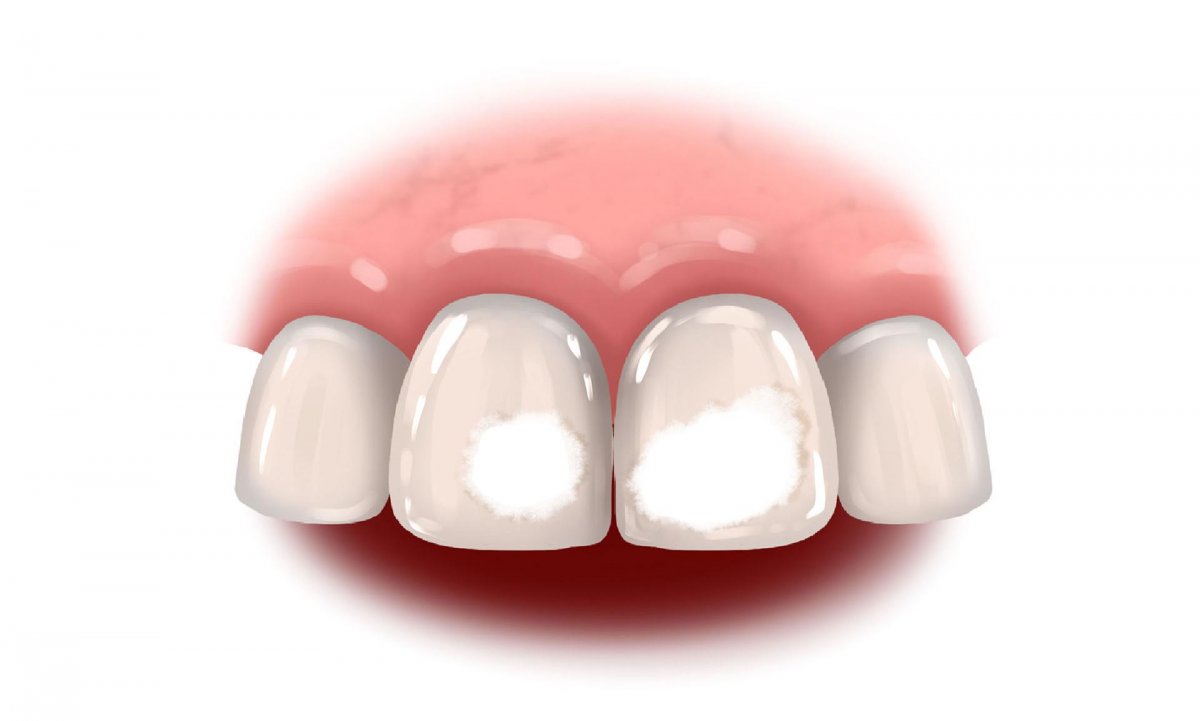 Белые пятна на зубах у ребенка