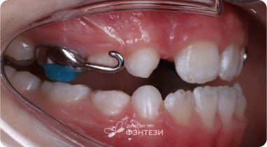 Поймали нарушения прикуса в раннем возрасте. Не допустили ортогнатическую операцию!