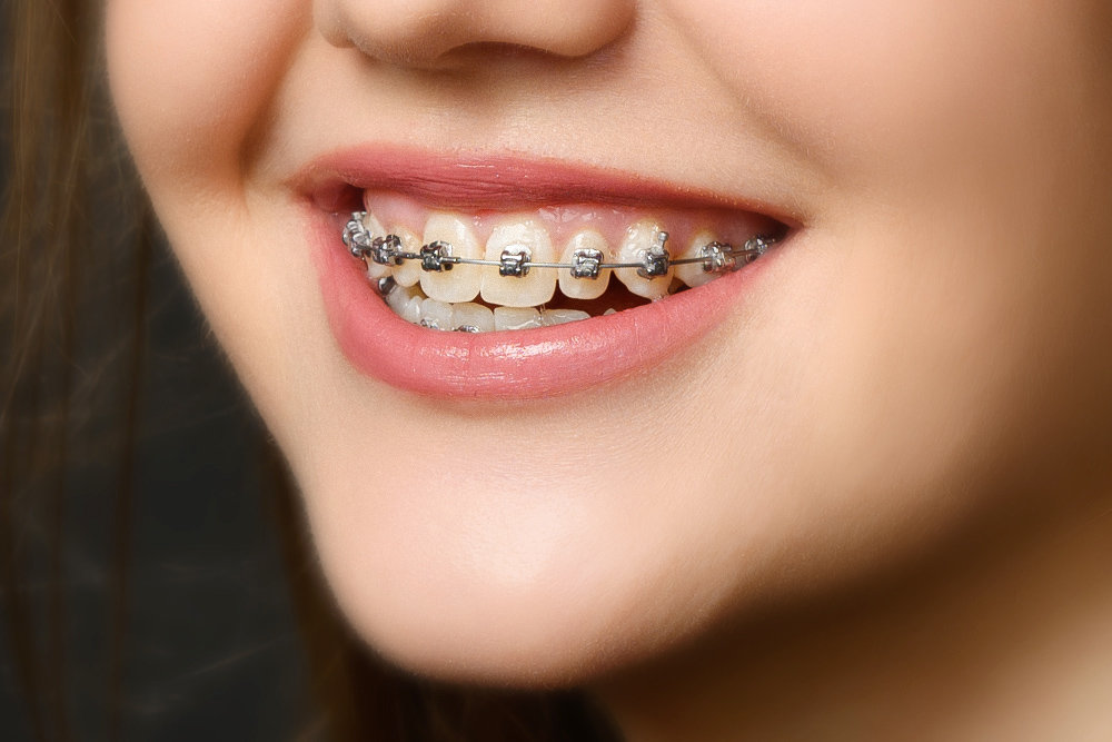 Брекеты для детей и подростков