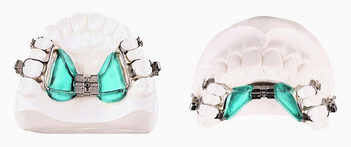Аппарат Хааса для расширения верхней челюсти