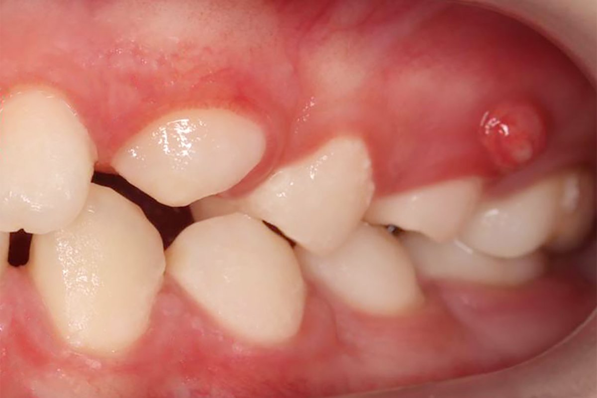 Свищ на десне у ребенка. Что делать родителям?