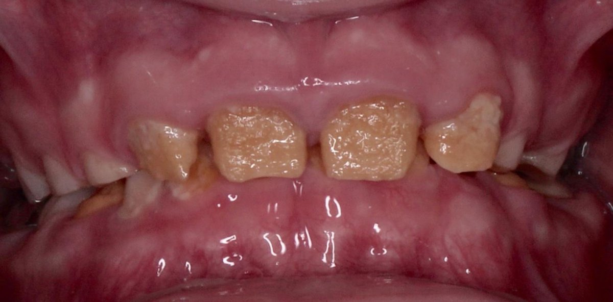 Гипоплазия эмали зубов