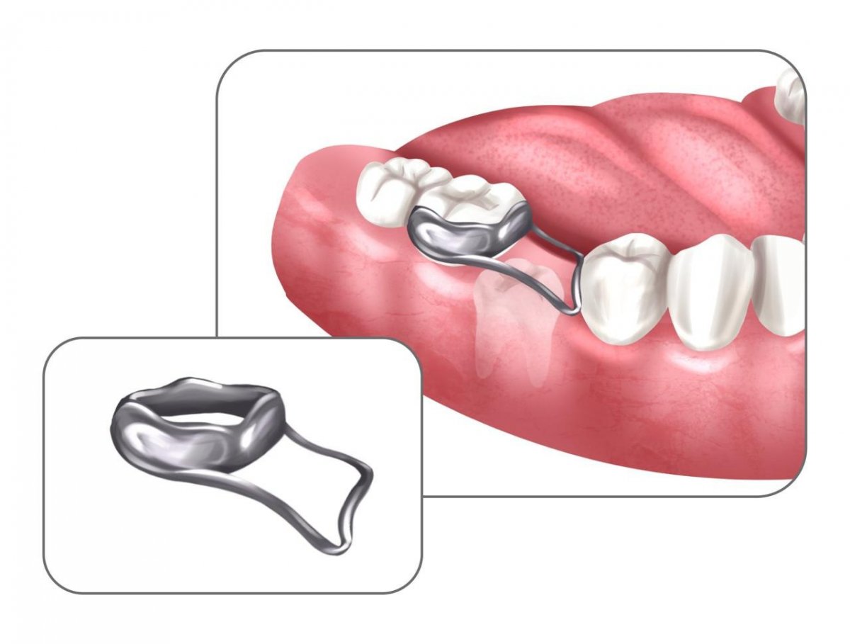 Ортодонтическое кольцо с распоркой в Москве