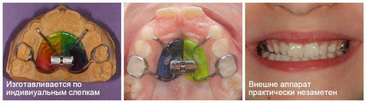 Несъемный аппарат для расширения верхней челюсти (аппарат Марко Роса)