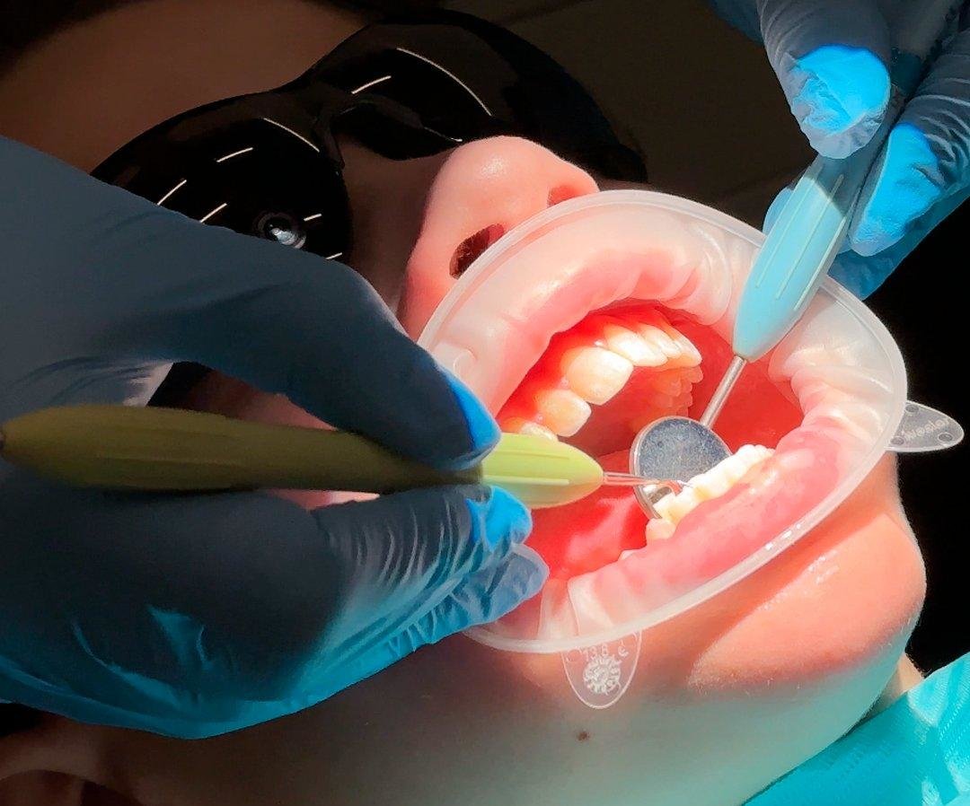 У ребенка зуб растет вторым рядом – причины, последствия и решение проблемы