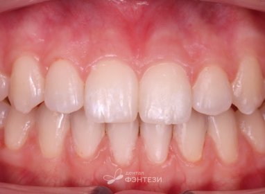 Решили все проблемы с прикусом за 1 год и 2 месяца