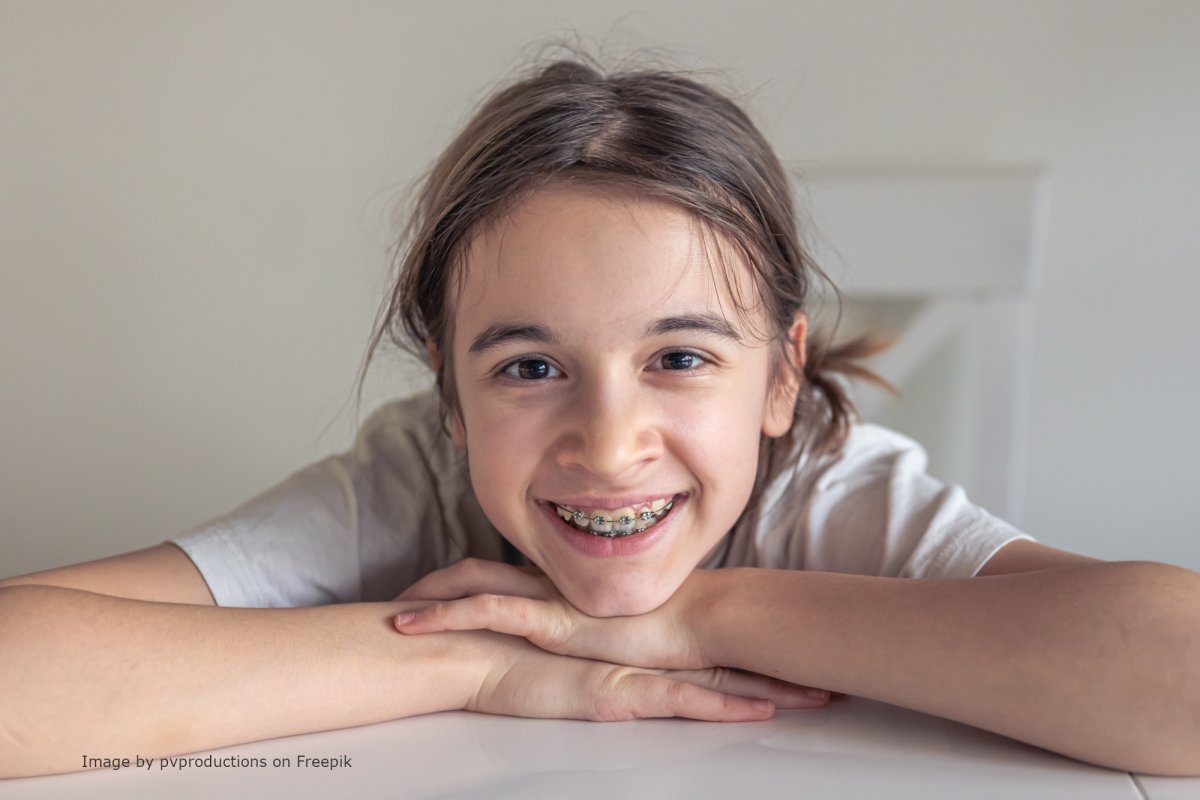 Что ставят на зубы после ношения брекетов