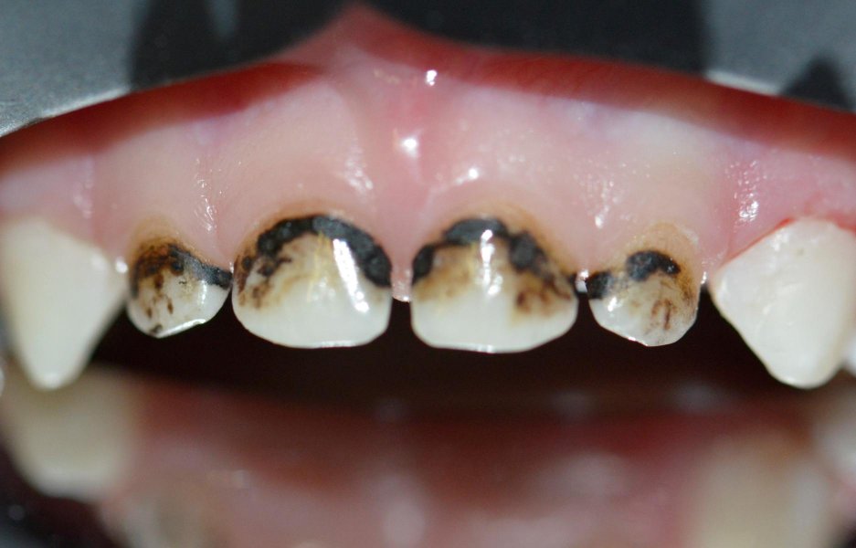 Серебрение зубов у детей - в вопросах и ответах