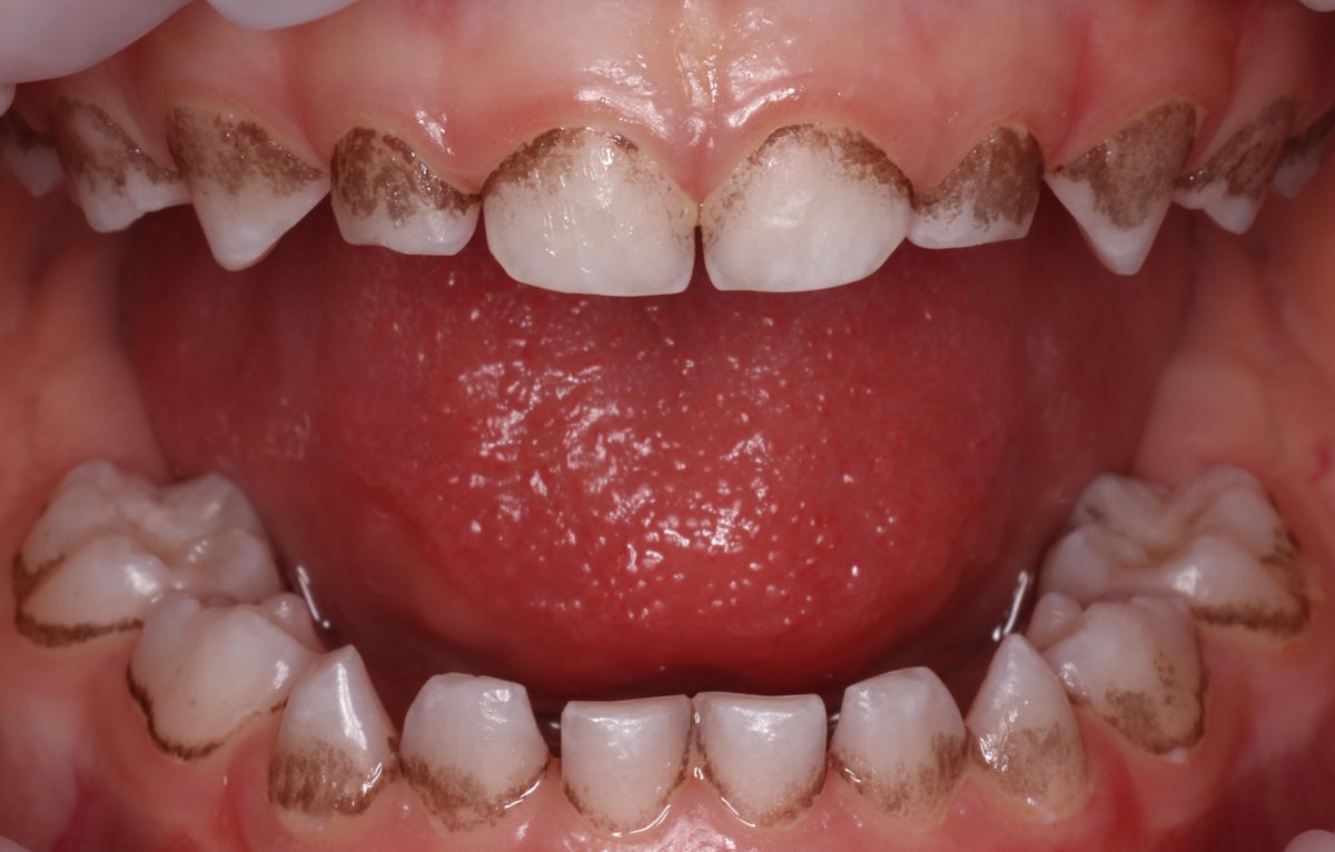 Черный налет у ребенка