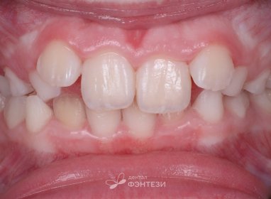 Решили все проблемы прикуса с помощью несъемного аппарата